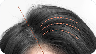 điều trị rụng tóc