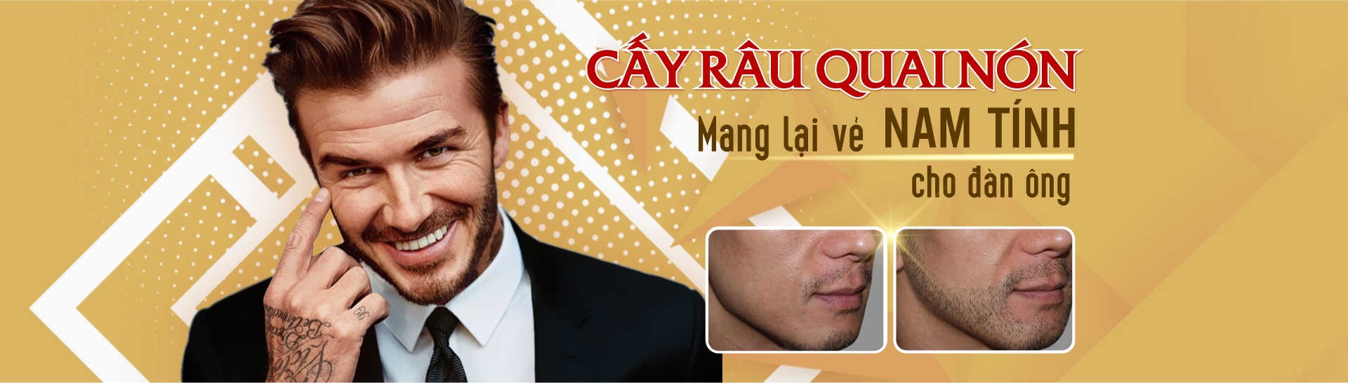 cấy râu quai nón