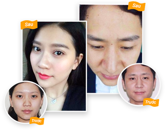 Hình ảnh trước và sau khi cấy lông mày Hinh anh truoc va sau khi cay long may