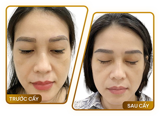 Phương pháp cấy lông mày