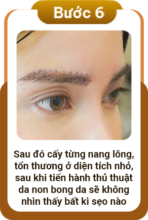 Quy trình cấy lông mày