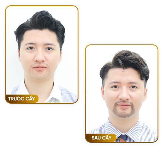 Phương pháp cấy râu tự thân