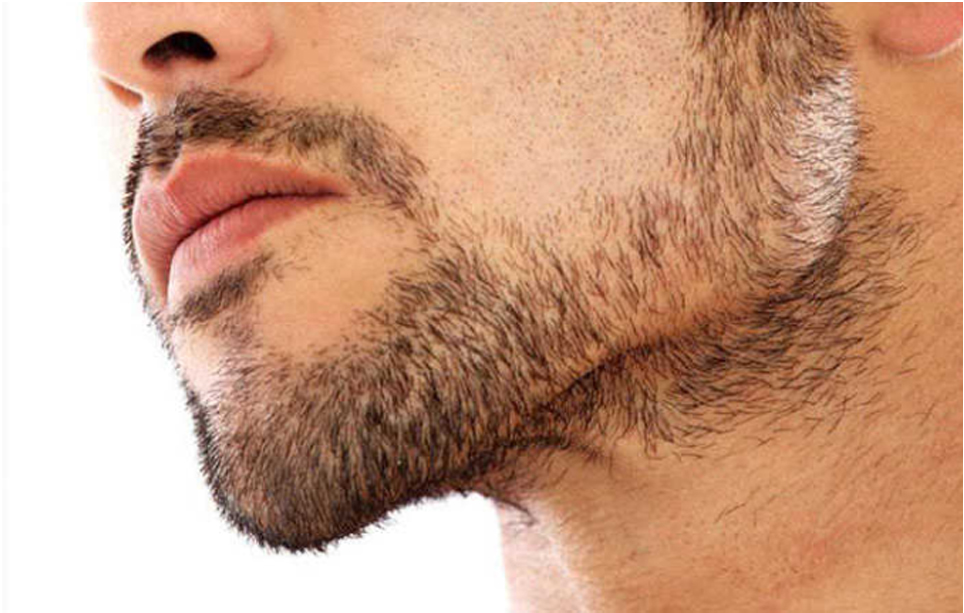 Phương pháp cấy râu tự thân