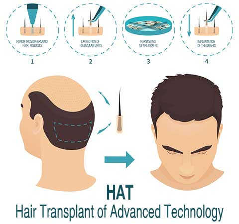 Cấy tóc tự thân FUT Cay toc tu than FUT