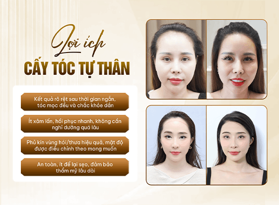 Phương pháp cấy tóc tự thân - trước và sau