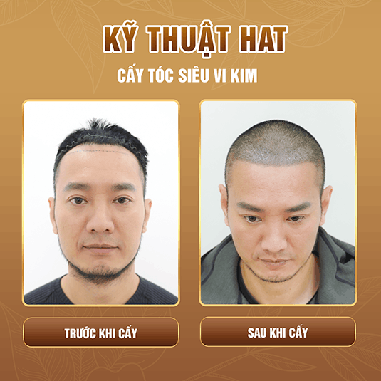 Phương pháp cấy tóc tự thân - trước và sau