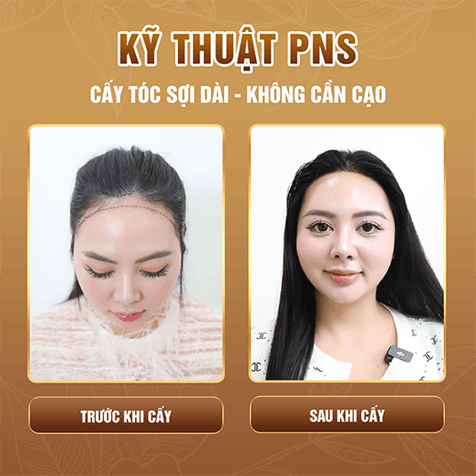 Phương pháp cấy tóc tự thân - trước và sau