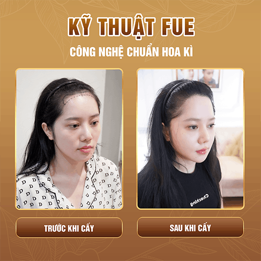 Phương pháp cấy tóc tự thân - trước và sau