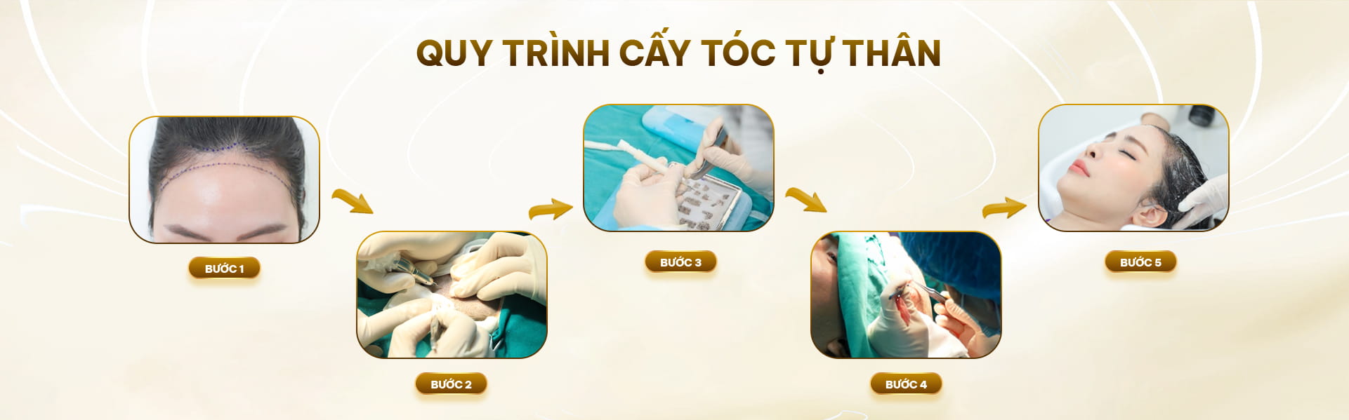 Phương pháp cấy tóc tự thân