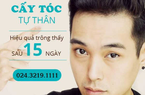 cấy tóc có hiệu quả không