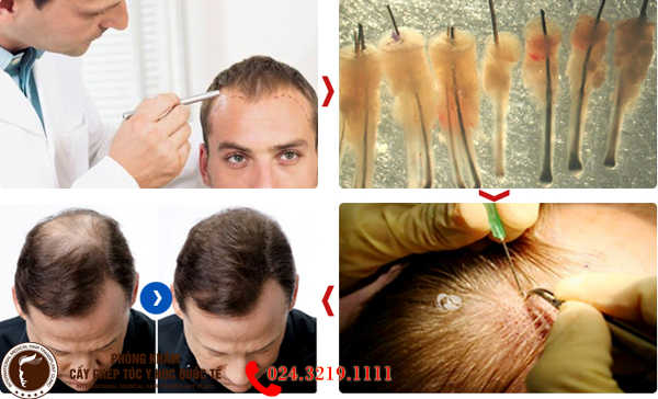 Cấy tóc có gây ảnh hưởng đến khu vực đầu không