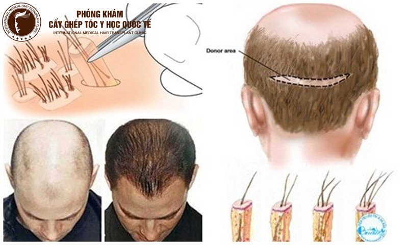 Phương pháp chữa hói đầu dứt điểm ở nam giới