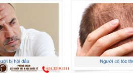 ai nên cấy tóc trị hói đầu