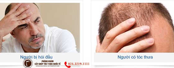ai nên cấy tóc trị hói đầu