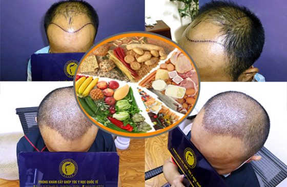 ăn gì sau khi cấy tóc