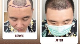 cấy tóc giữ được bao lâu