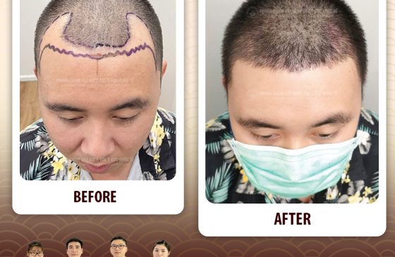 cấy tóc giữ được bao lâu