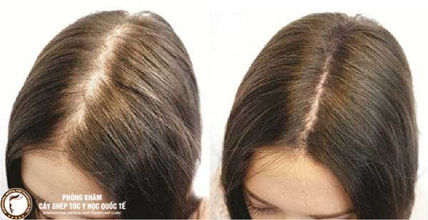 cấy tóc tự thân chữa hói đầu tối ưu ở nữ