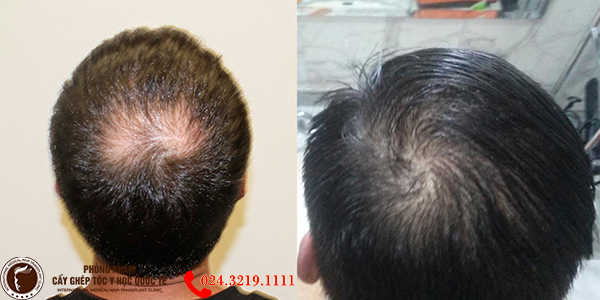 [CHIA SẺ] Nguyên nhân gây rụng tóc ở nam giới