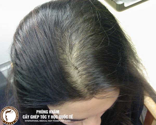 5 Cách khắc phục tóc thưa ở đỉnh đầu nữ nhanh và hiệu quả  VIETSKIN