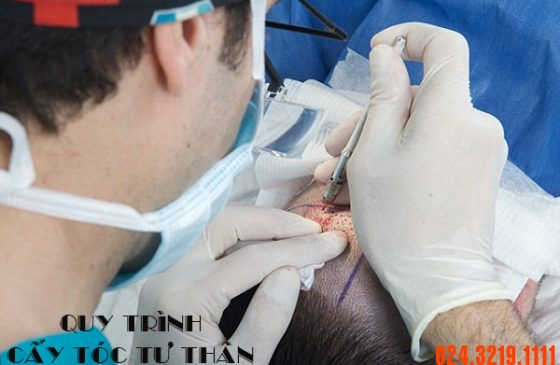 quy trình cấy tóc tự thân