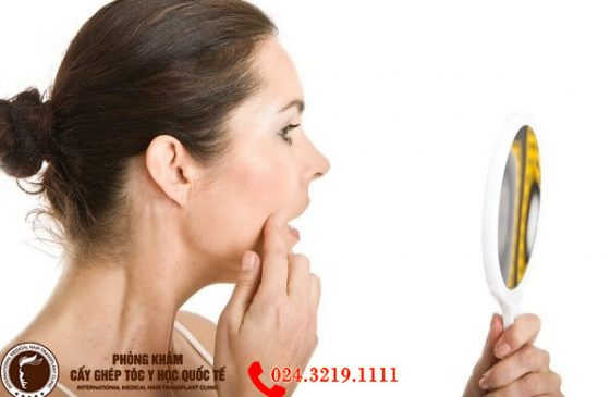 rụng tóc do nội tiết tố