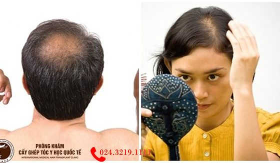 thận yếu gây rụng tóc