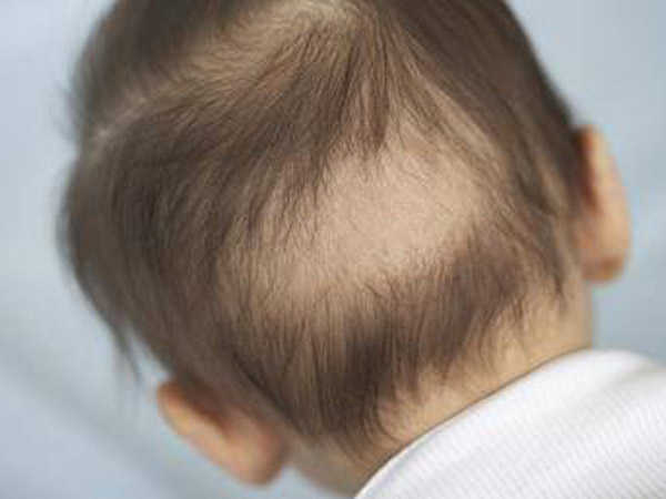 trẻ sơ sinh bị rụng tóc hình vành khăn