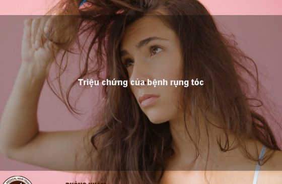 triệu chứng tóc rụng nhiều ở nữ