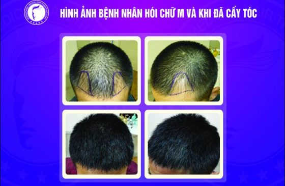 cấy tóc tự thân có bị rụng lại không