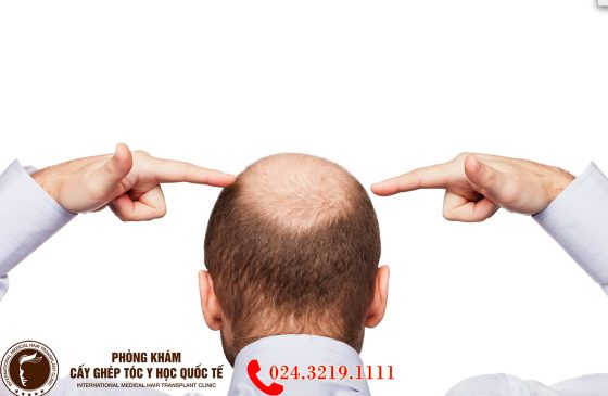 rụng tóc do thay đổi nội tiết tố hay androgenetic