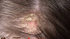 bệnh viêm da đầu gây rụng tóc