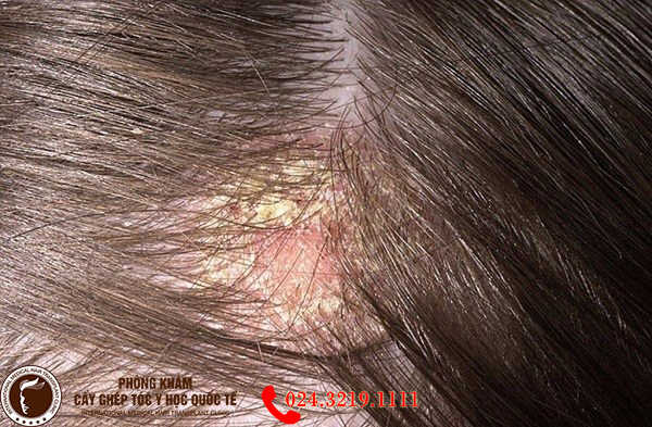 bệnh viêm da đầu gây rụng tóc