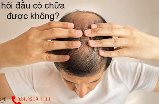 hói đầu có chữa được không