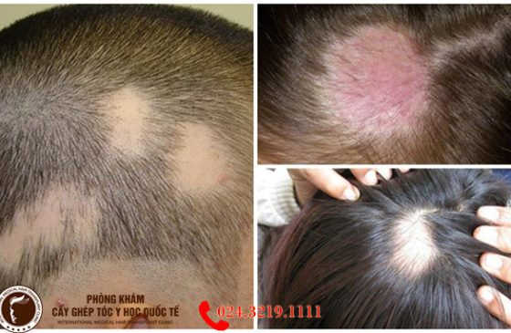 rụng tóc từng mảng