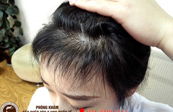 sau cấy tóc tự thân cần chú ý gì