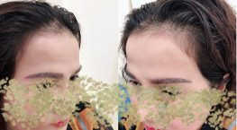 ảnh cấy lông mày