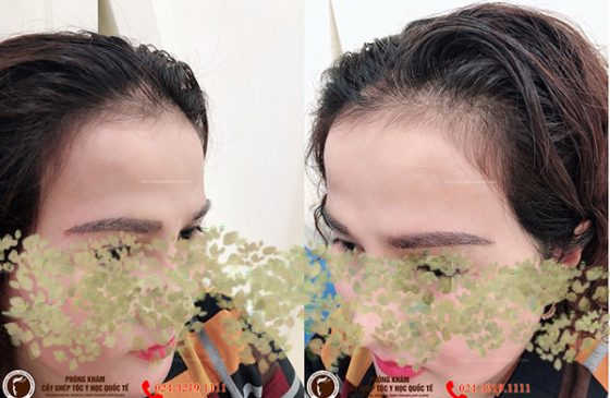 ảnh cấy lông mày