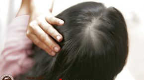 chữa viêm chân tóc tránh rụng tóc