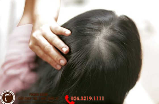 chữa viêm chân tóc tránh rụng tóc