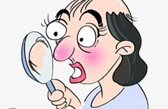 dấu hiệu bị hói đầu