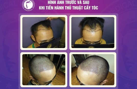 ai đã từng đi cấy tóc