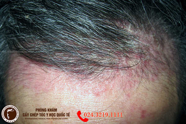 Phân biệt nấm da đầu và gàu  đọc để không nhầm lẫn gây nguy hại  iCare  Pharma