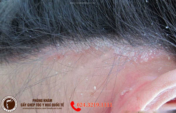 Nguy cơ lão hóa tóc da đầu ở nam giới tuổi 30  VnExpress Sức khỏe