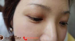 rụng lông mày