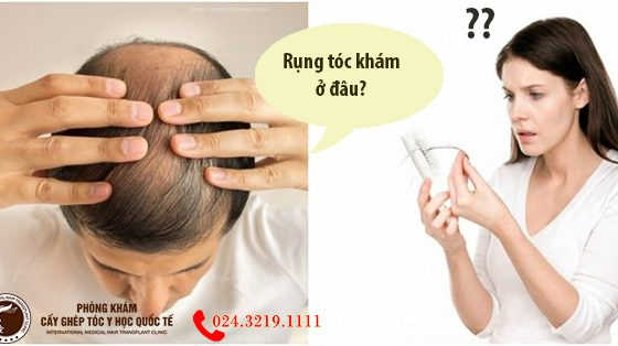 rụng tóc khám ở đâu