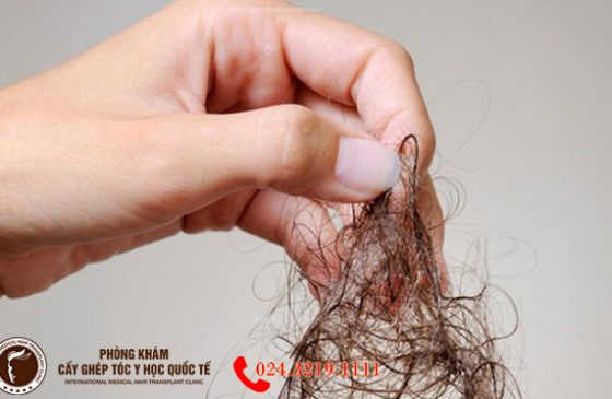 rụng tóc nhiều khi gội đầu