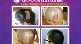 xóa sẹo trên da đầu