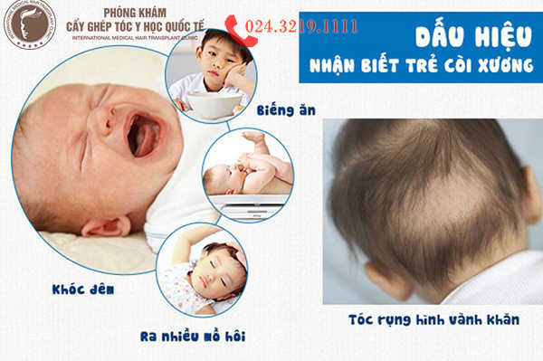 rụng tóc hình vành khăn ở trẻ sơ sinh