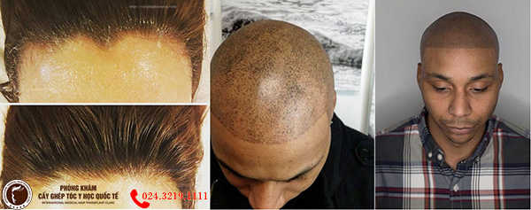 ưu nhược điểm của xăm tóc chữa hói đầu